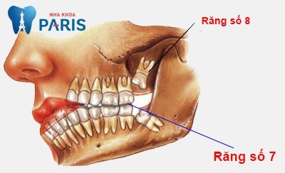 răng số 7 hàm dưới bị sâu